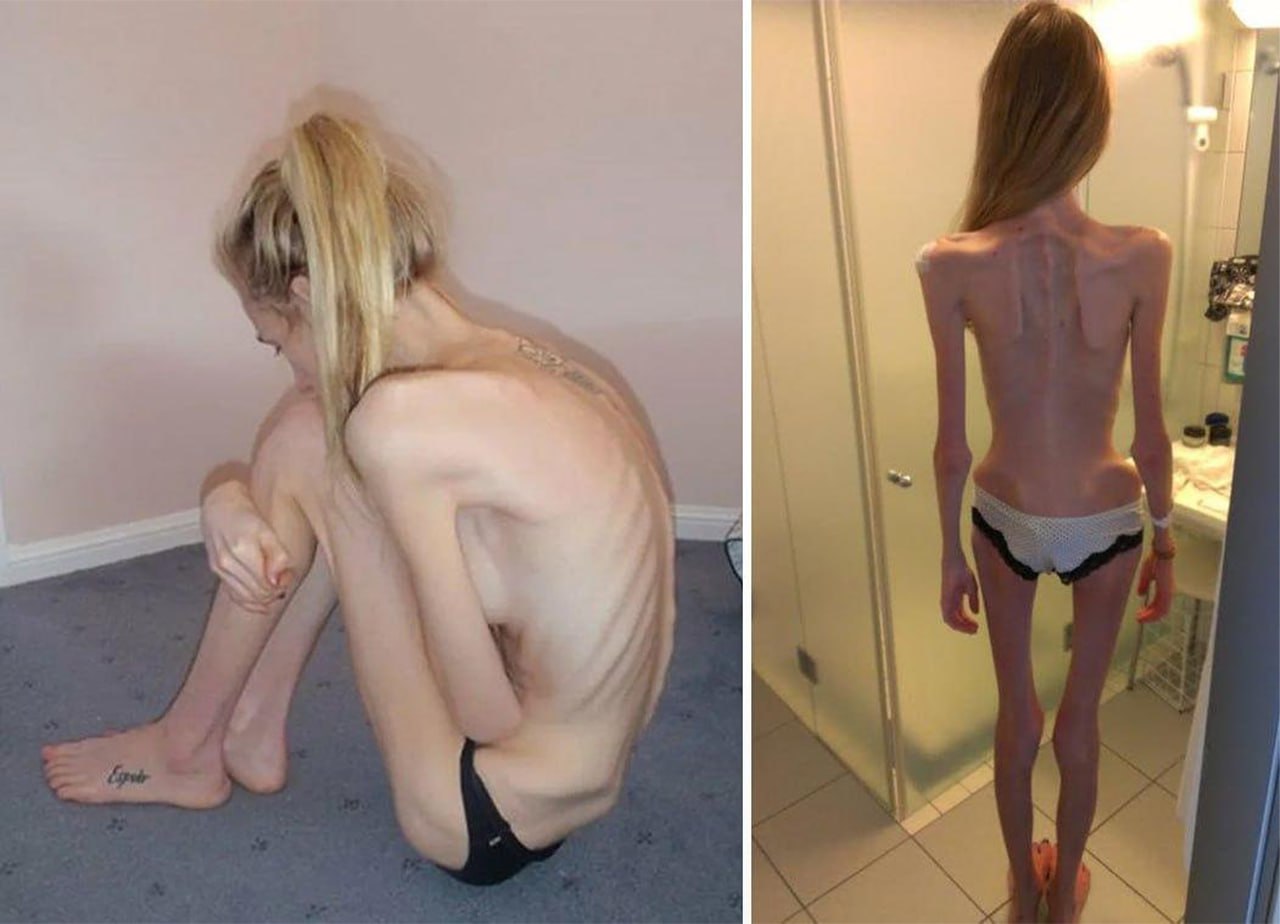 Anorexia, chelsea's story